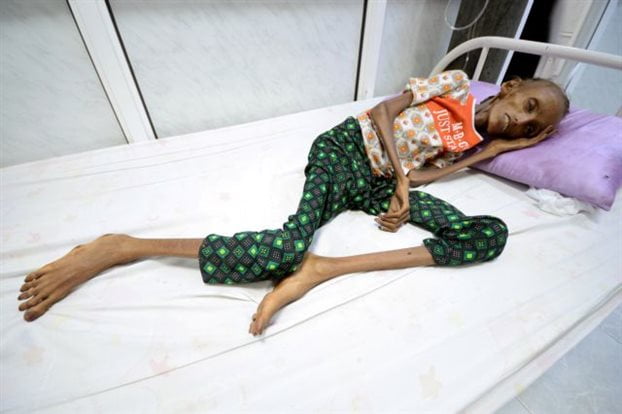 ΟΗΕ: Σοκαριστική η κατάσταση στην Υεμένη