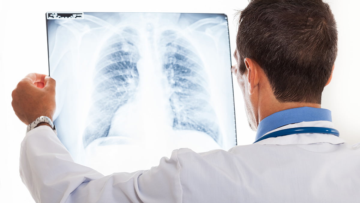Καρκίνος πνεύμονα: Πρώτη αιτία θανάτου στην Ελλάδα – Σωτήρια η πρώιμη διάγνωση